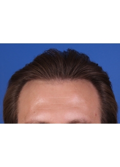 After Hair Transplant&nbsp;2 Sessions (Areas)